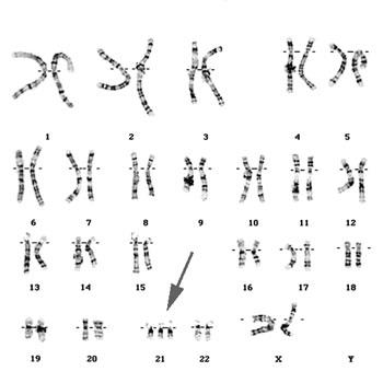 21 de março: Dia Internacional da Síndrome de Down